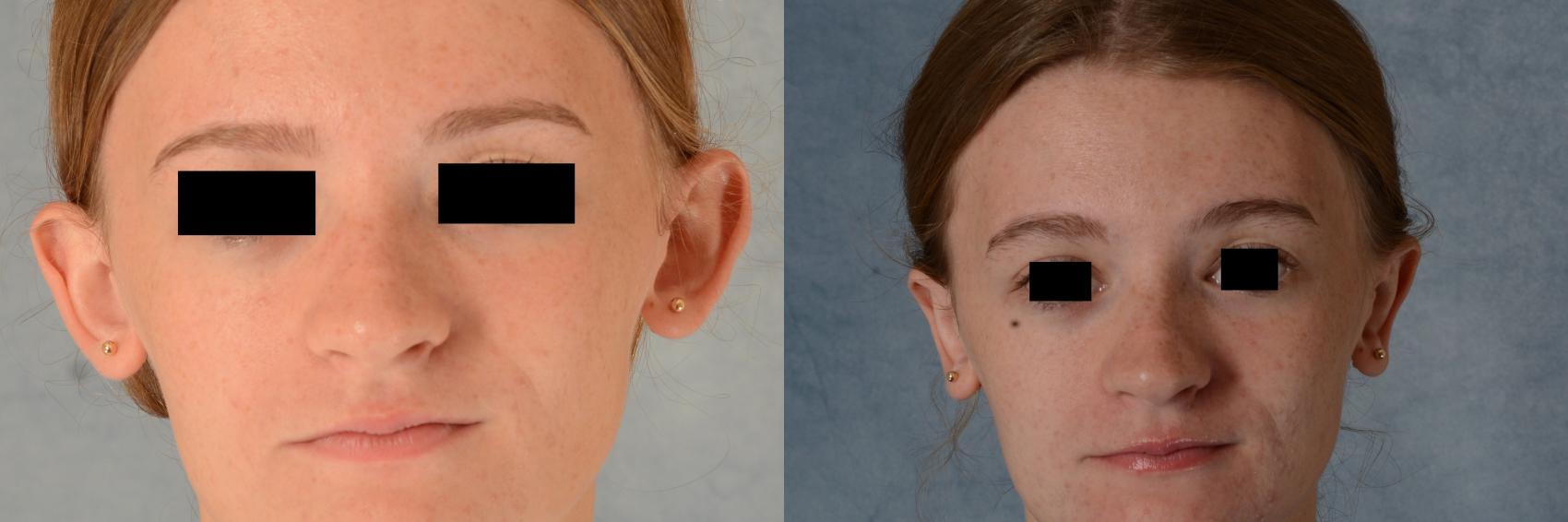 Before & After Otoplasty Case 590 Front View in Tallahassee, FL