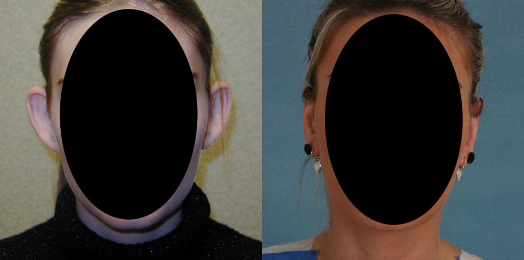 Before & After Otoplasty Case 73 View #1 View in Tallahassee, FL