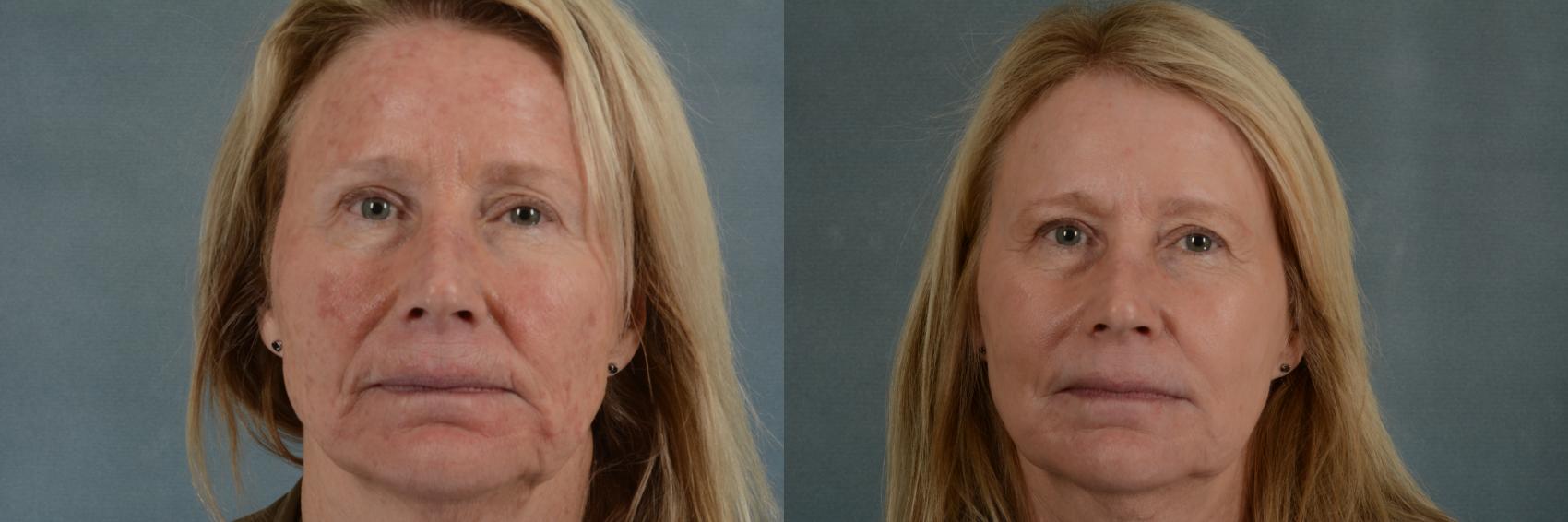 Before & After Physician Performed Chemical Peels Case 266 View #1 View in Tallahassee, FL