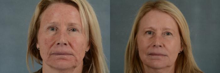 Before & After Physician Performed Chemical Peels Case 266 View #1 View in Tallahassee, FL