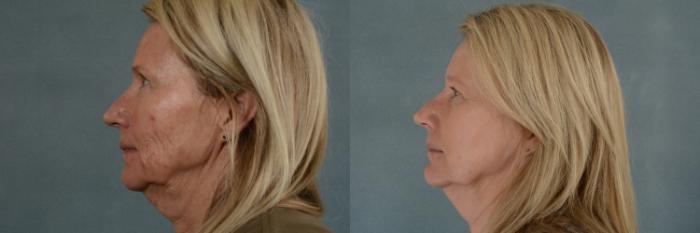 Before & After Physician Performed Chemical Peels Case 266 View #2 View in Tallahassee, FL