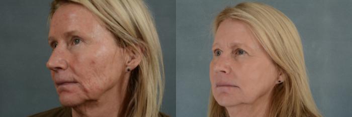 Before & After Physician Performed Chemical Peels Case 266 View #3 View in Tallahassee, FL