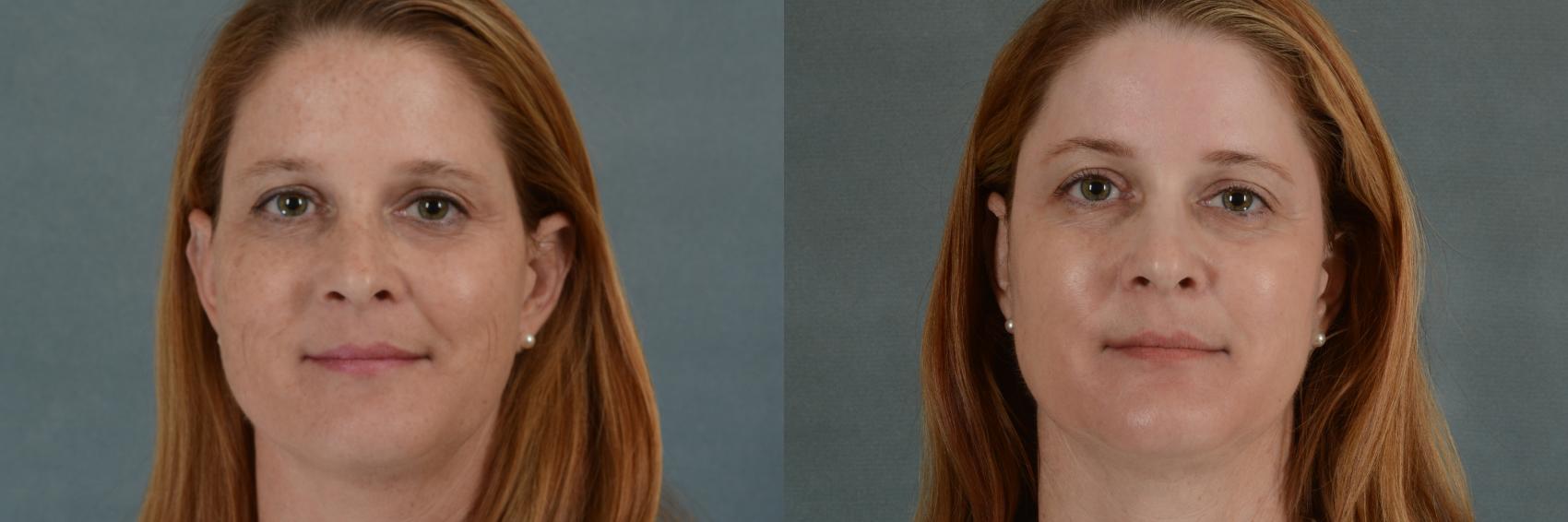 Before & After Physician Performed Chemical Peels Case 272 View #1 View in Tallahassee, FL