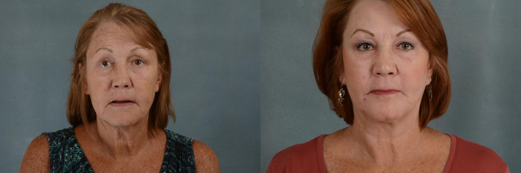 Before & After Physician Performed Chemical Peels Case 286 View #1 View in Tallahassee, FL