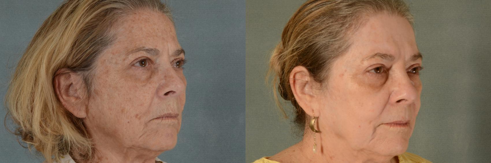 Before & After Physician Performed Chemical Peels Case 361 View #3 View in Tallahassee, FL
