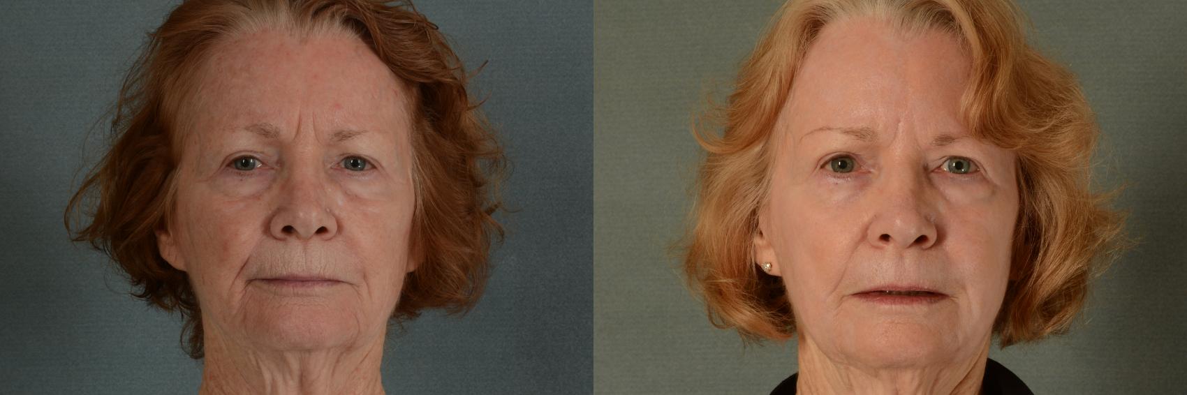 Before & After Physician Performed Chemical Peels Case 412 View #1 View in Tallahassee, FL