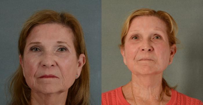 Before & After Physician Performed Chemical Peels Case 423 View #1 View in Tallahassee, FL