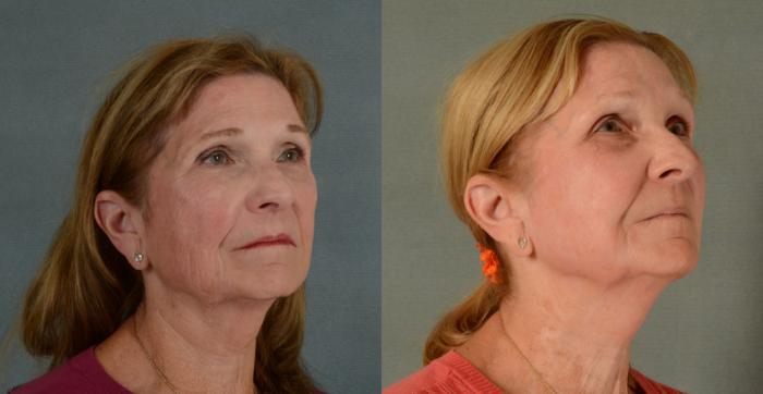 Before & After Physician Performed Chemical Peels Case 423 View #2 View in Tallahassee, FL