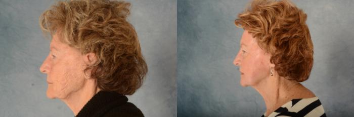 Before & After Physician Performed Chemical Peels Case 724 Left Side View in Tallahassee, FL