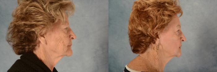 Before & After Physician Performed Chemical Peels Case 724 Right Side View in Tallahassee, FL