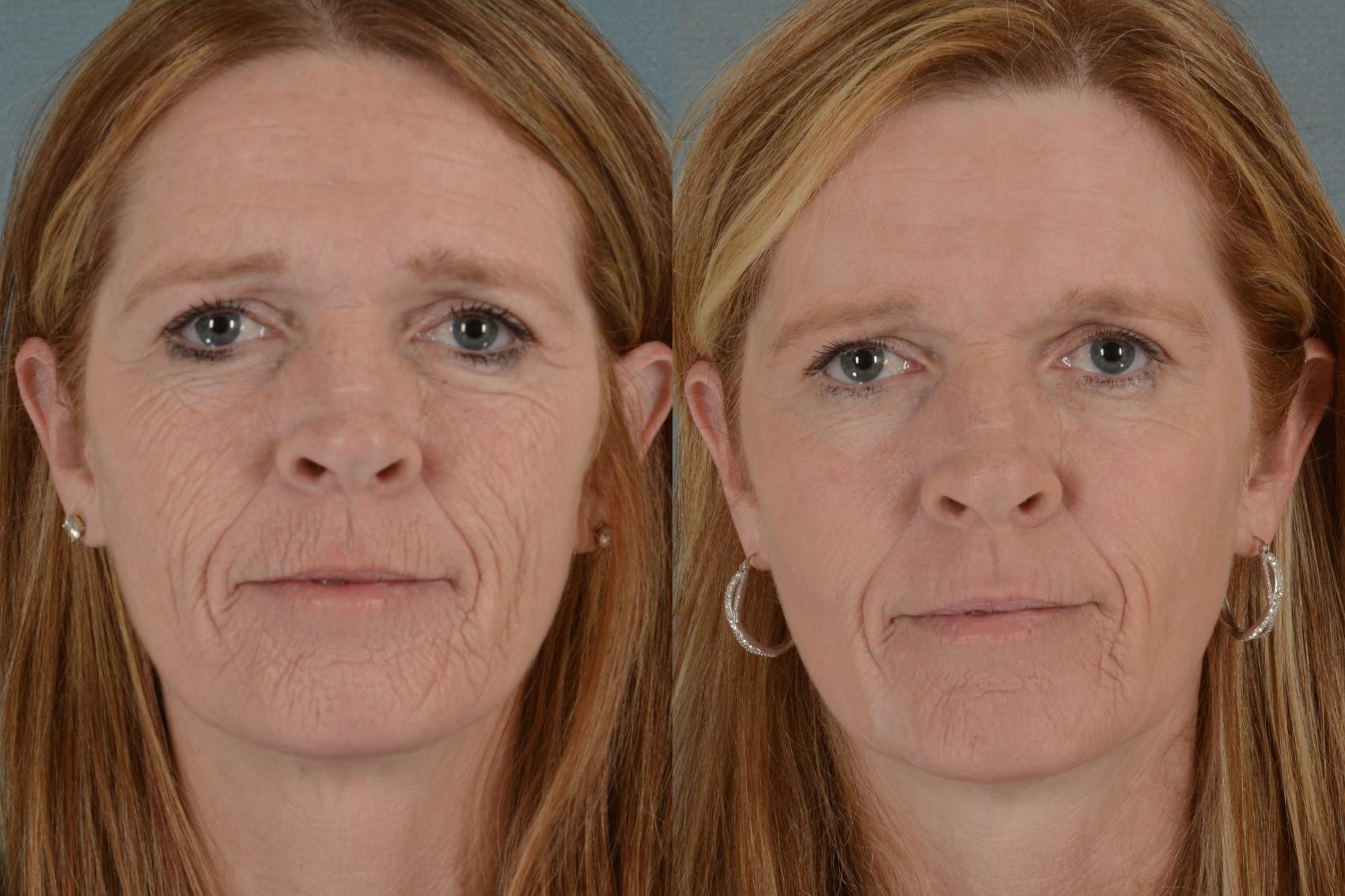 Before & After Physician Performed Chemical Peels Case 75 View #1 View in Tallahassee, FL
