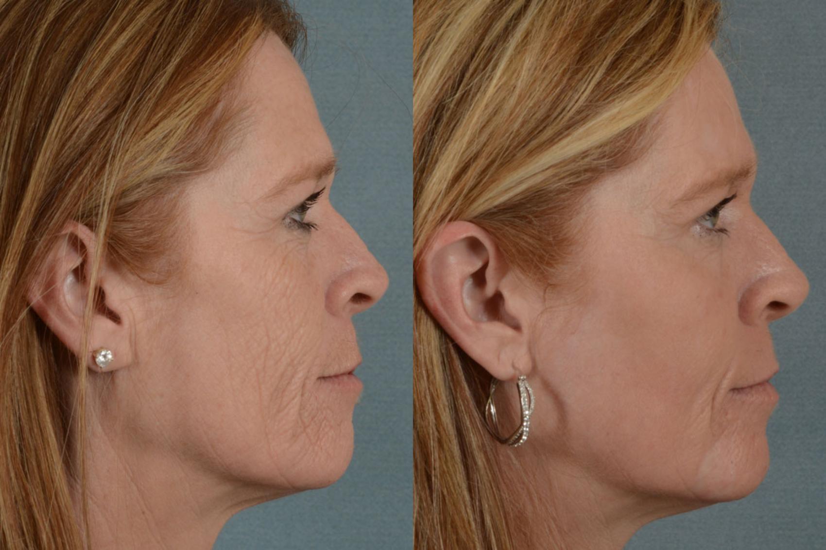 Before & After Physician Performed Chemical Peels Case 75 View #2 View in Tallahassee, FL