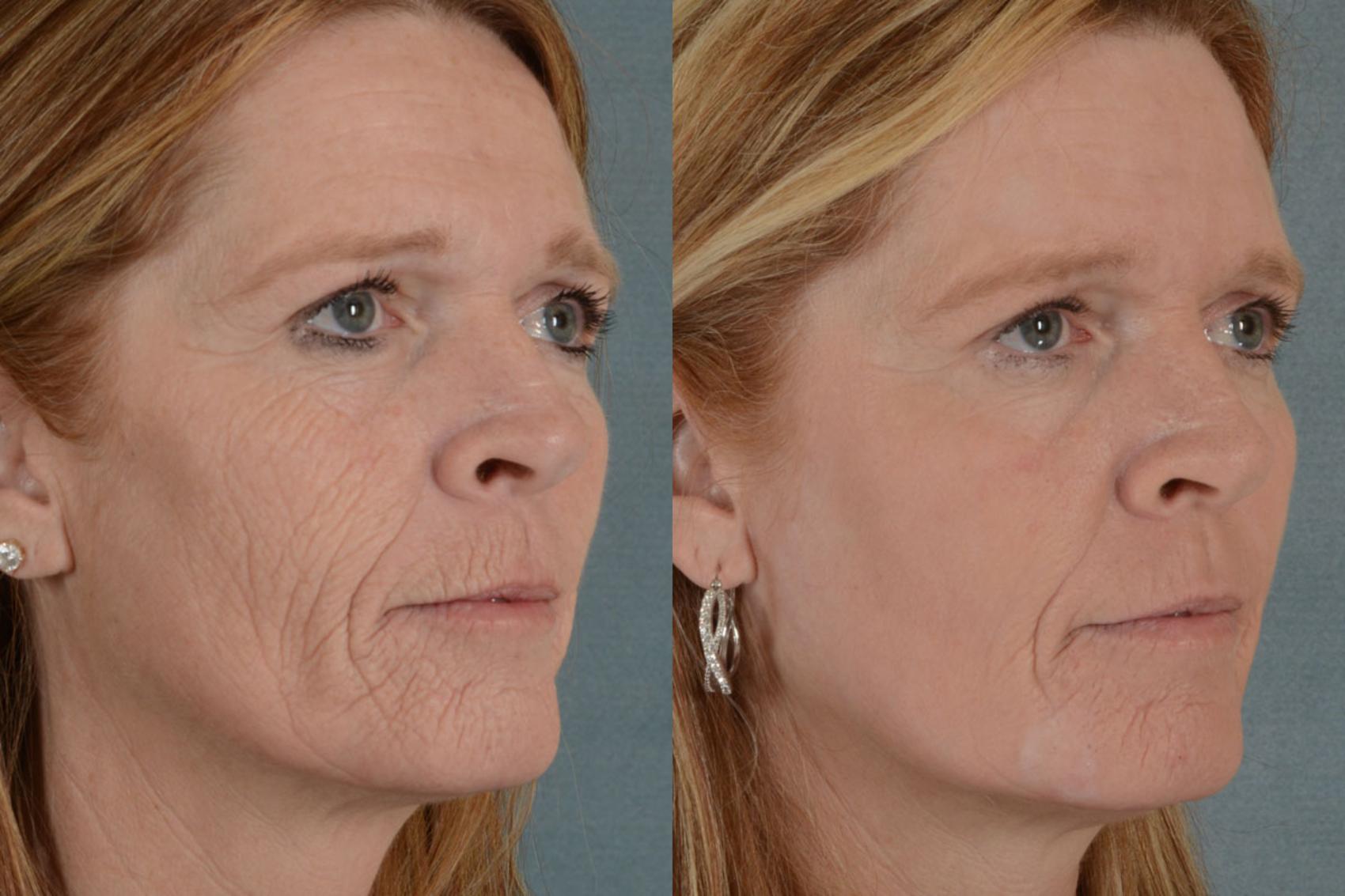 Before & After Physician Performed Chemical Peels Case 75 View #3 View in Tallahassee, FL