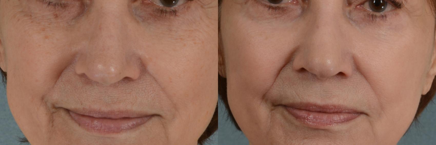 Before & After Physician Performed Chemical Peels Case 76 View #1 View in Tallahassee, FL