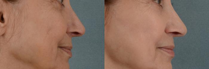 Before & After Physician Performed Chemical Peels Case 76 View #2 View in Tallahassee, FL