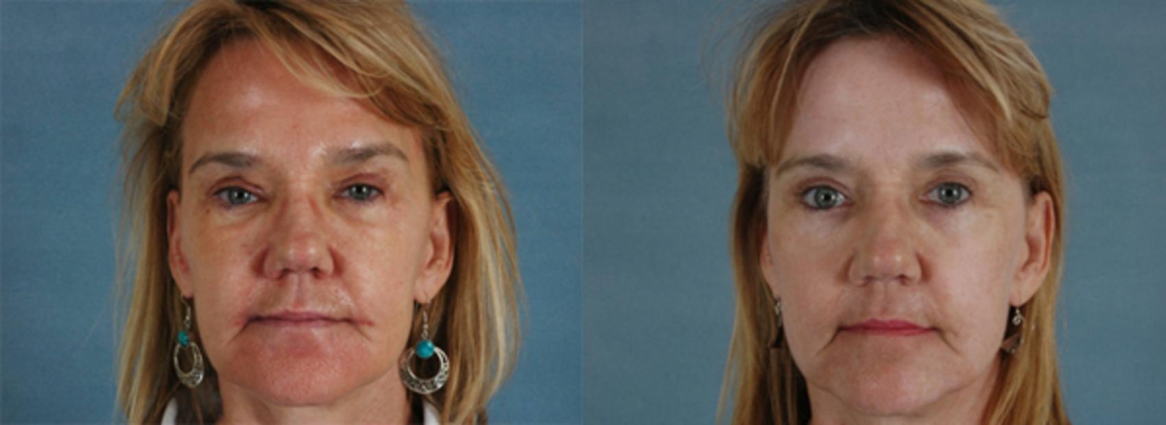 Before & After Physician Performed Chemical Peels Case 79 View #1 View in Tallahassee, FL