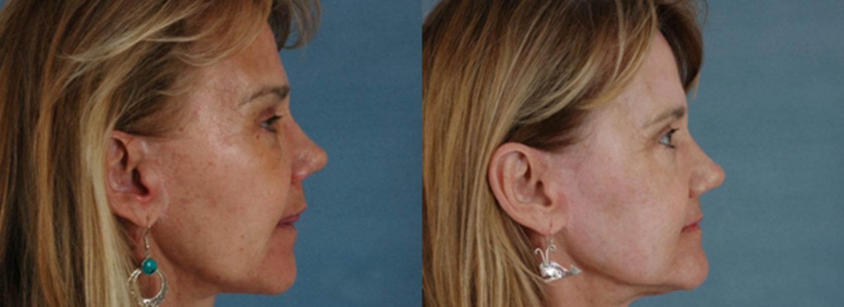 Before & After Physician Performed Chemical Peels Case 79 View #2 View in Tallahassee, FL