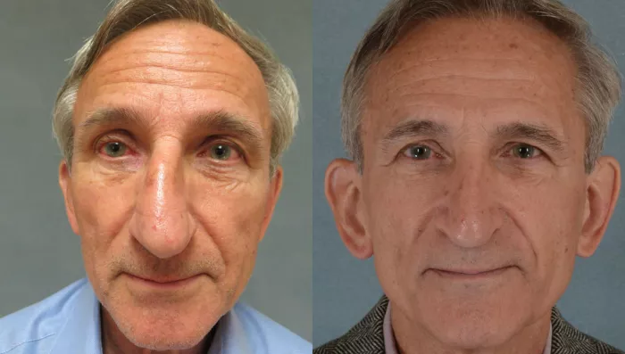 rhinoplasty-1-view-1-thumbnail