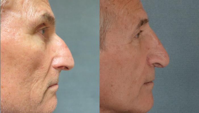 Before & After Rhinoplasty Case 1 View #2 View in Tallahassee, FL