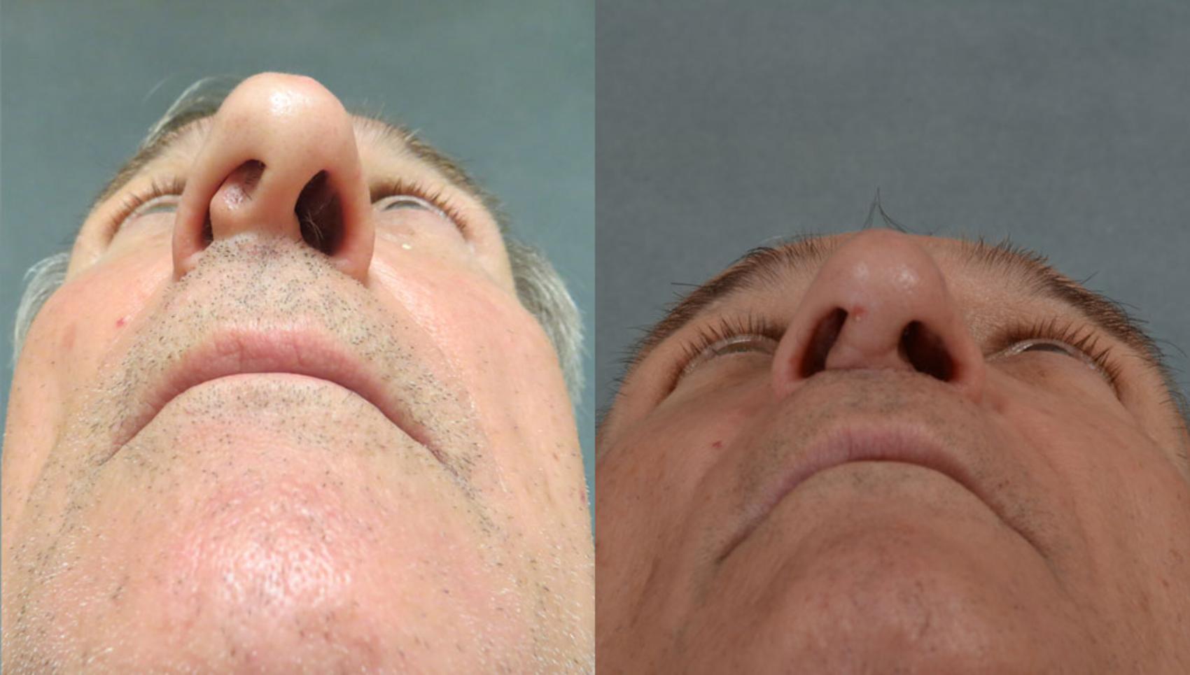 Before & After Rhinoplasty Case 1 View #3 View in Tallahassee, FL
