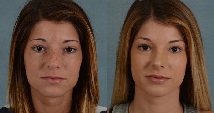 Before & After Rhinoplasty Case 2 View #1 View in Tallahassee, FL