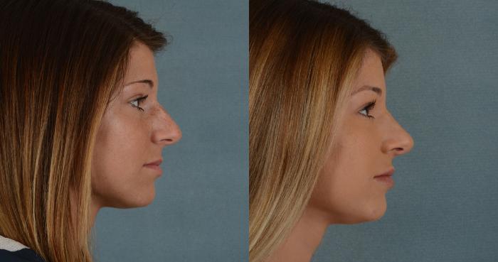 Before & After Rhinoplasty Case 2 View #2 View in Tallahassee, FL