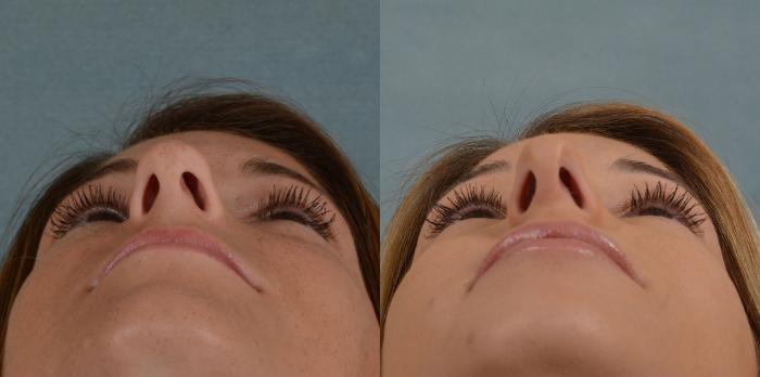 Before & After Rhinoplasty Case 2 View #3 View in Tallahassee, FL