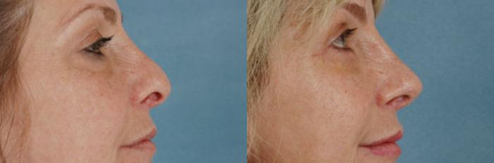Before & After Rhinoplasty Case 3 View #1 View in Tallahassee, FL