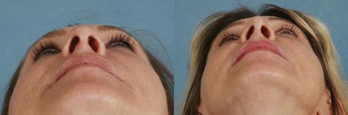 Before & After Rhinoplasty Case 3 View #3 View in Tallahassee, FL