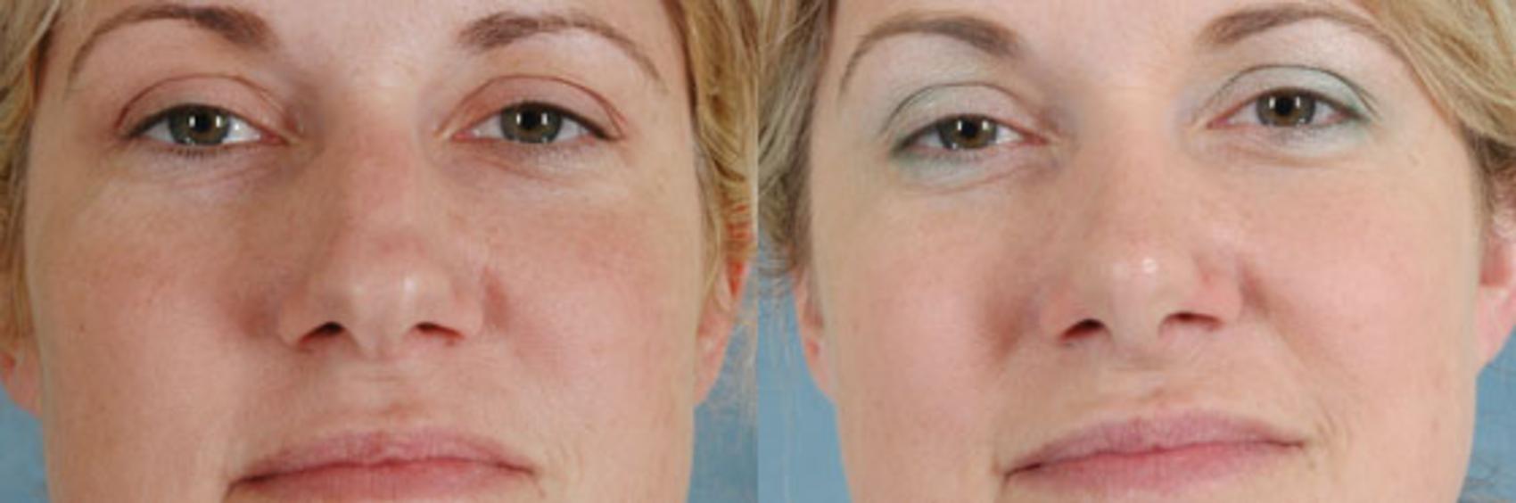 Before & After Rhinoplasty Case 4 View #1 View in Tallahassee, FL