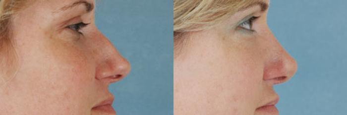 Before & After Rhinoplasty Case 4 View #2 View in Tallahassee, FL