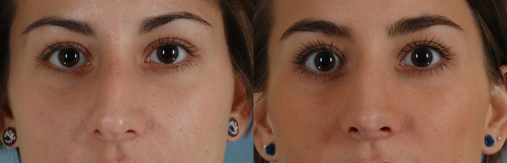 Before & After Rhinoplasty Case 5 View #1 View in Tallahassee, FL