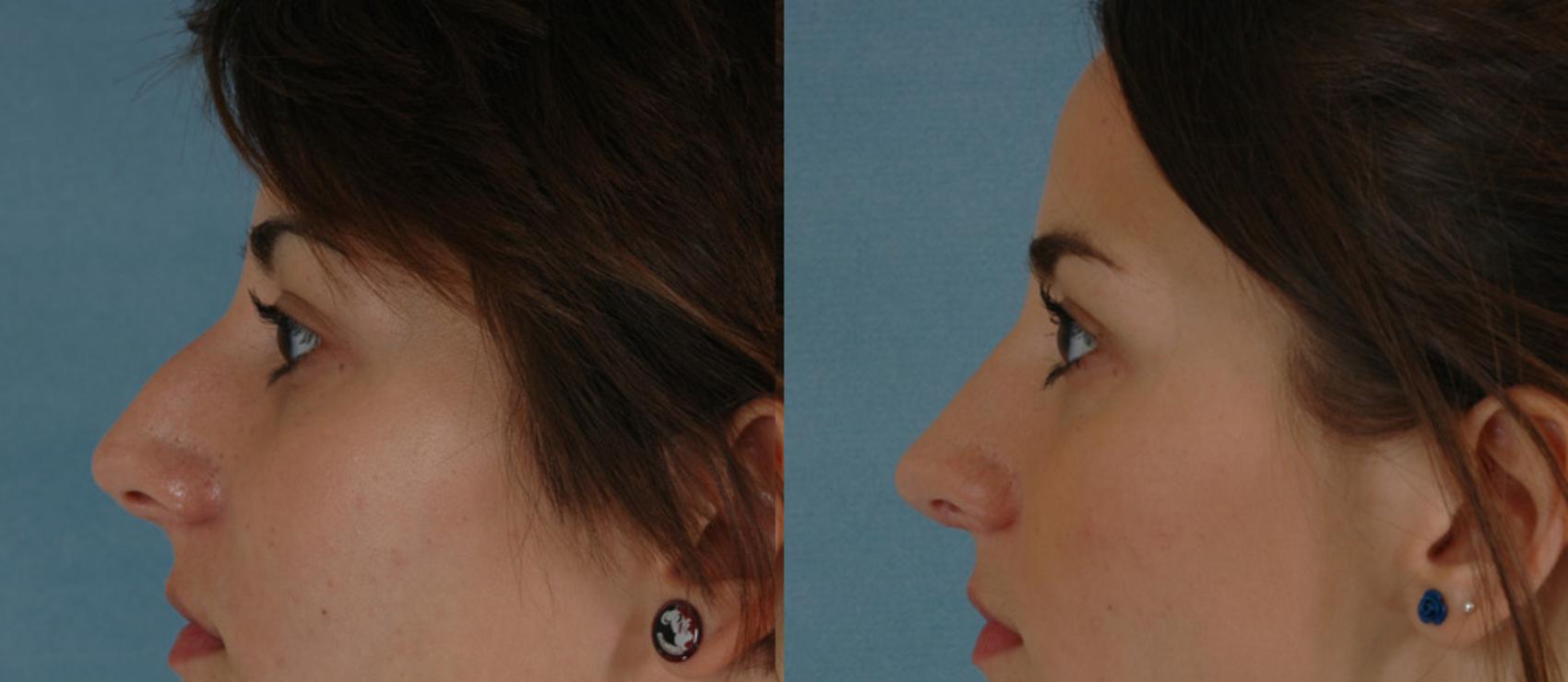 Before & After Rhinoplasty Case 5 View #2 View in Tallahassee, FL