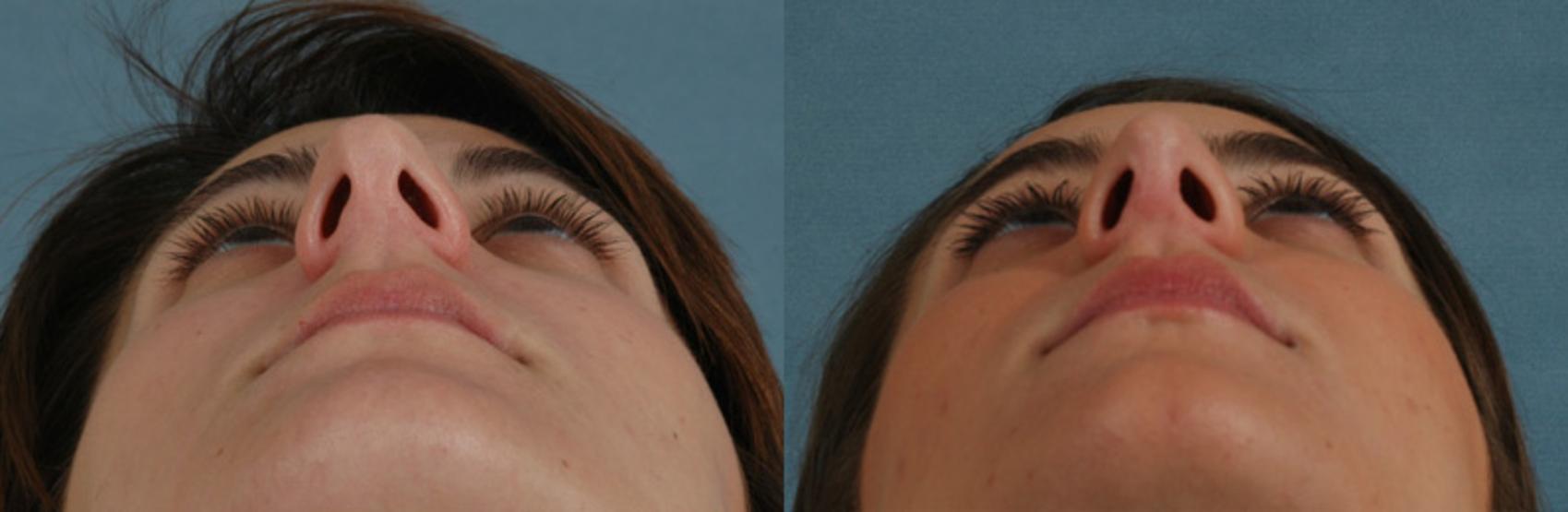 Before & After Rhinoplasty Case 5 View #3 View in Tallahassee, FL