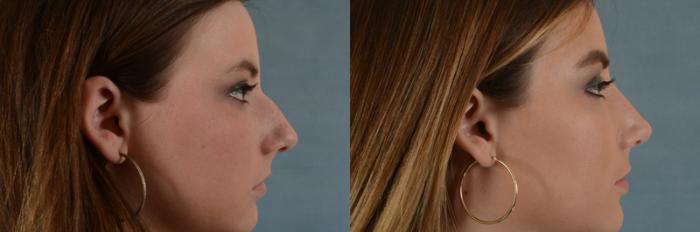 Before & After Rhinoplasty Case 6 View #2 View in Tallahassee, FL