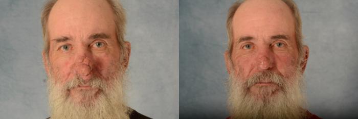 Before & After Rhinoplasty Case 624 Front View in Tallahassee, FL