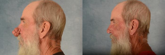 Before & After Rhinoplasty Case 624 Left Side View in Tallahassee, FL