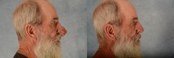 Before & After Rhinoplasty Case 624 Right Side View in Tallahassee, FL