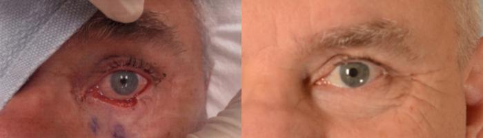 Before & After Skin Cancer Repair Case 522 Front View in Tallahassee, FL