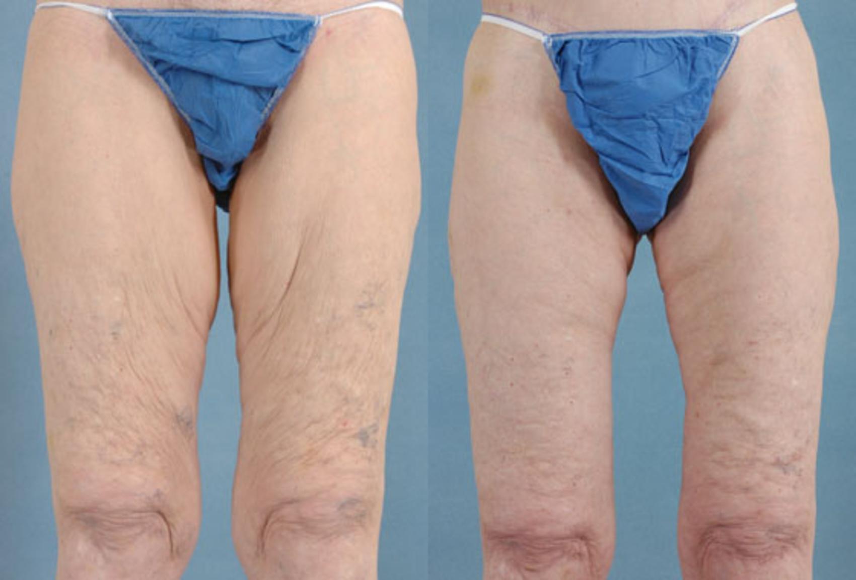 Before & After Thigh Lift Case 115 View #1 View in Tallahassee, FL