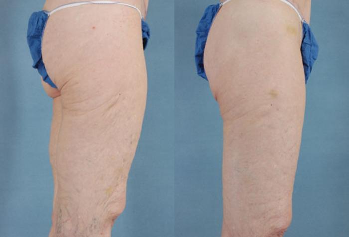 Before & After Thigh Lift Case 115 View #2 View in Tallahassee, FL