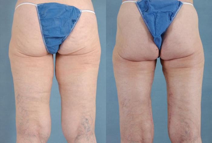 Before & After Thigh Lift Case 115 View #3 View in Tallahassee, FL