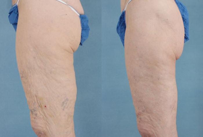 Before & After Thigh Lift Case 115 View #4 View in Tallahassee, FL