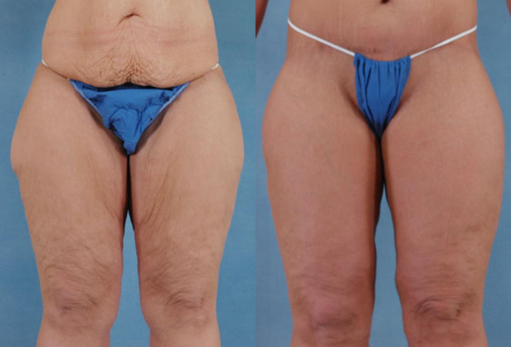 Before & After Thigh Lift Case 116 View #1 View in Tallahassee, FL