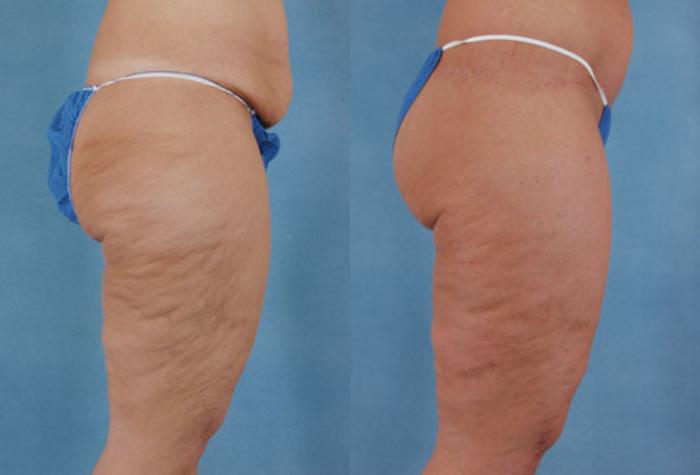 Before & After Thigh Lift Case 116 View #2 View in Tallahassee, FL
