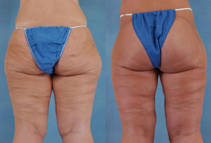 Before & After Thigh Lift Case 116 View #3 View in Tallahassee, FL