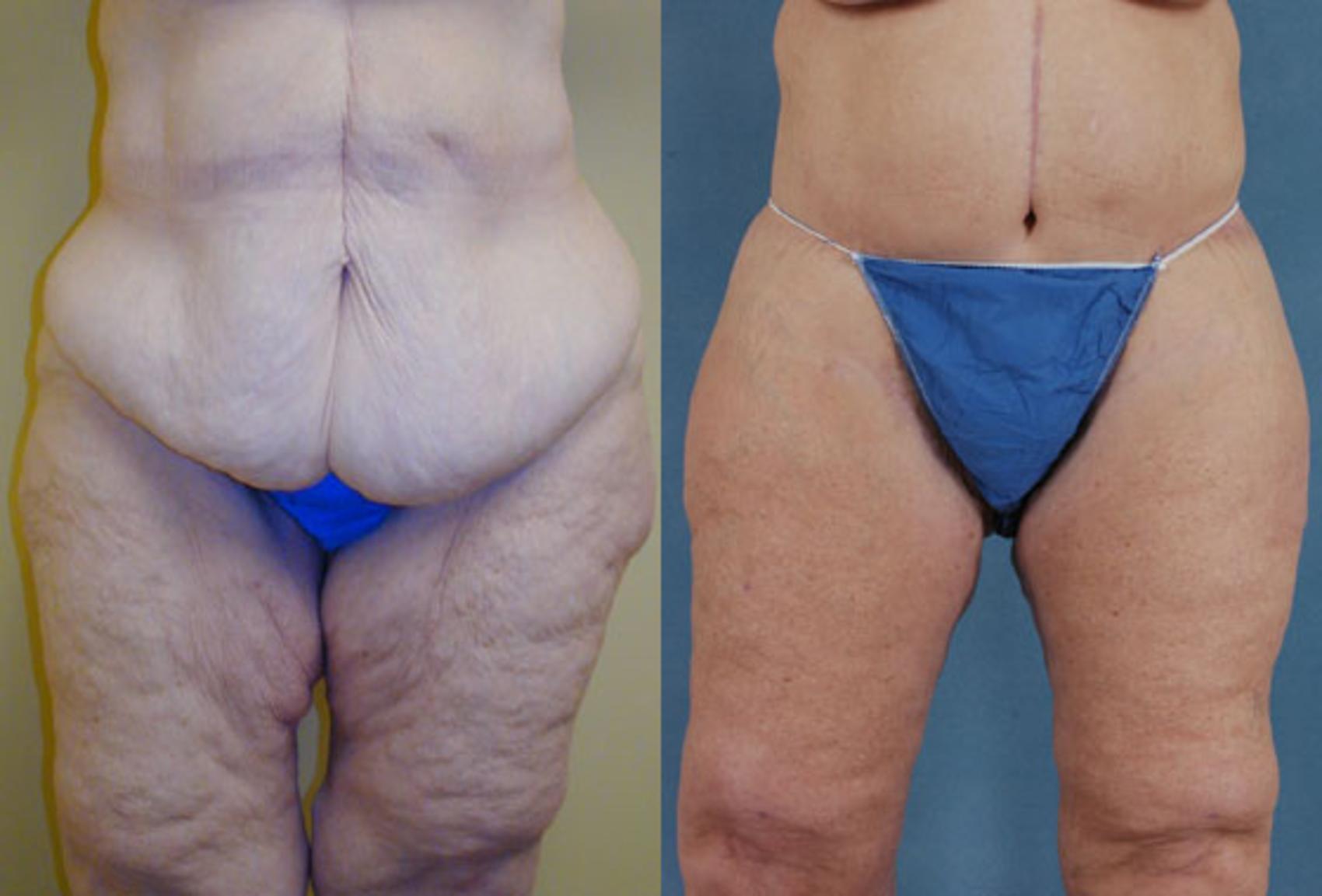 Before & After Thigh Lift Case 118 View #1 View in Tallahassee, FL