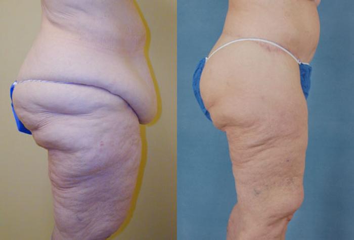 Before & After Thigh Lift Case 118 View #2 View in Tallahassee, FL