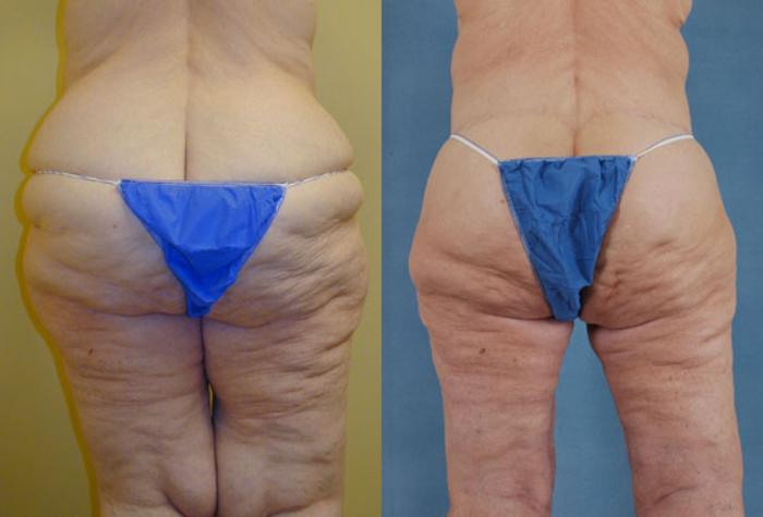 Before & After Thigh Lift Case 118 View #3 View in Tallahassee, FL