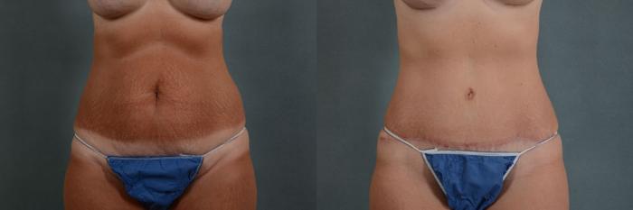 Before & After Tummy Tuck (Abdominoplasty) Case 119 View #1 View in Tallahassee, FL